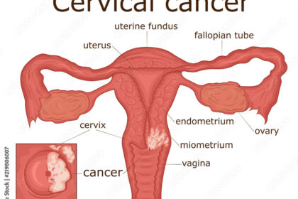 Cervical cancer