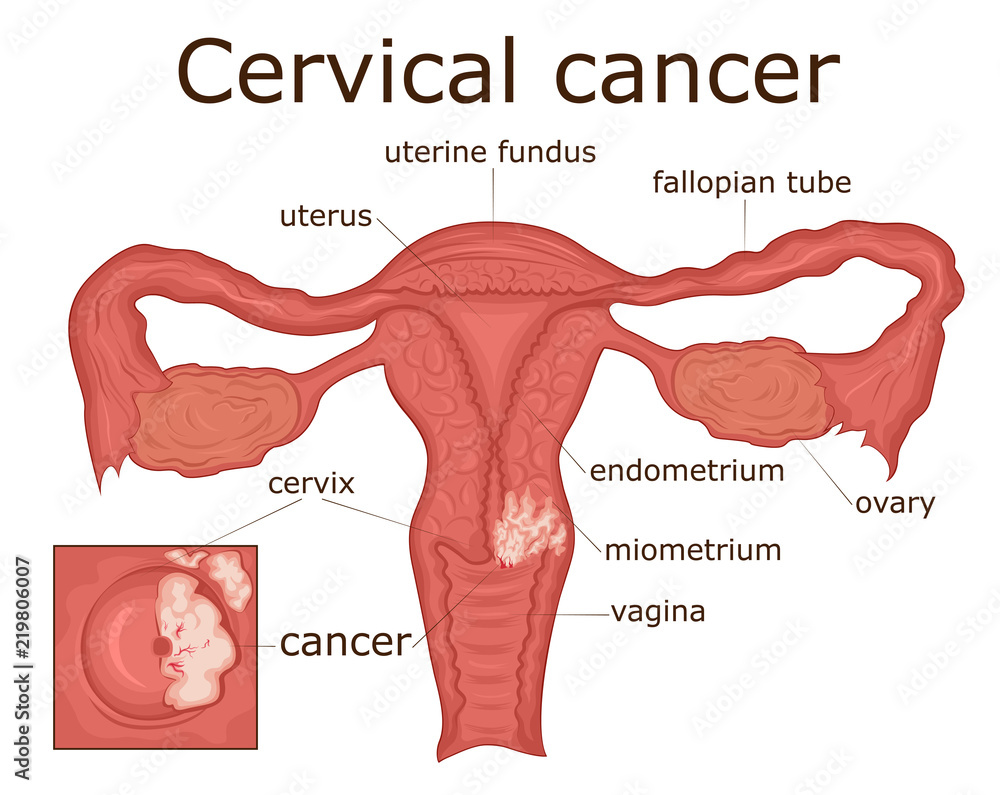 Cervical cancer