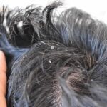 Dandruff