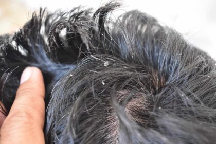 Dandruff