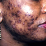 acne2