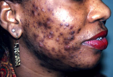 acne2
