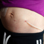 Exit site for peritoneal dialysis catheter