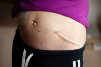 Exit site for peritoneal dialysis catheter