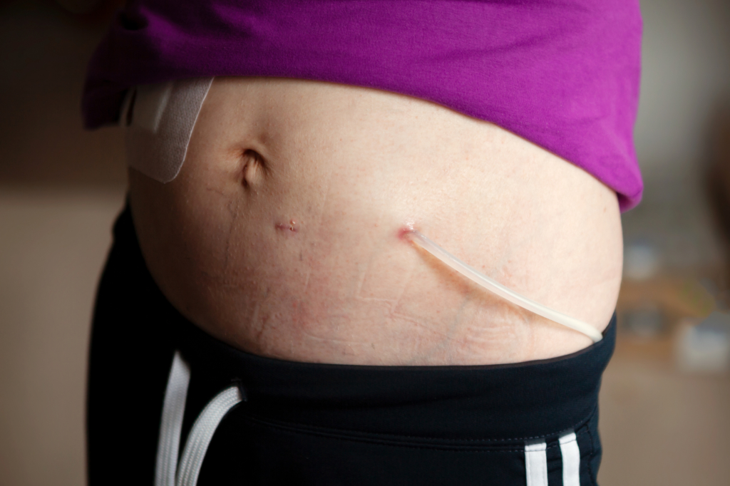 Exit site for peritoneal dialysis catheter