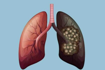 Lung Cancer. illustration: Warith International Cancer Institute