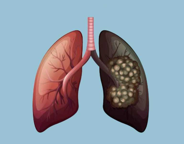 Why lung cancer is rising among non-smokers 1 Lung Cancer. illustration: Warith International Cancer Institute