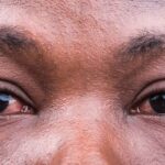 Intestinal worms play a significant role in the Nigeria's burden of blindness