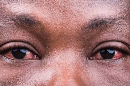 Intestinal worms play a significant role in the Nigeria's burden of blindness