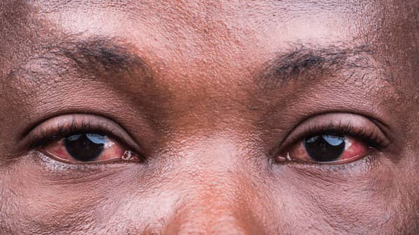 Intestinal worms play a significant role in the Nigeria's burden of blindness