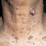 neurofibromatosis condition: Credit: WebMed