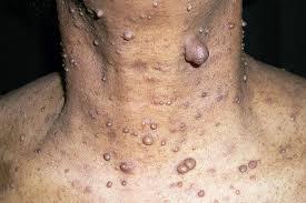 neurofibromatosis condition: Credit: WebMed